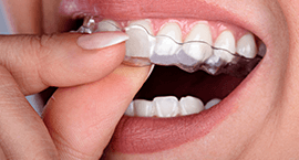 clear_aligners clear_aligners